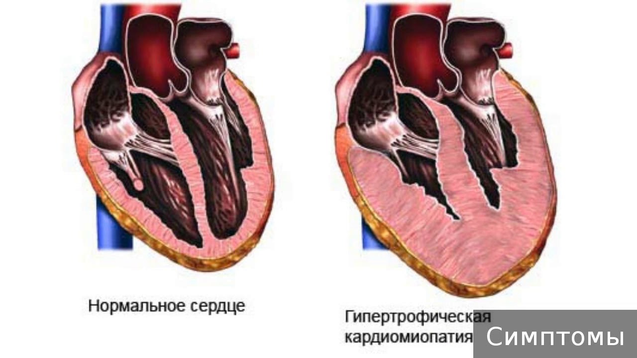 Аритмогенная кардиомиопатия правого желудочка