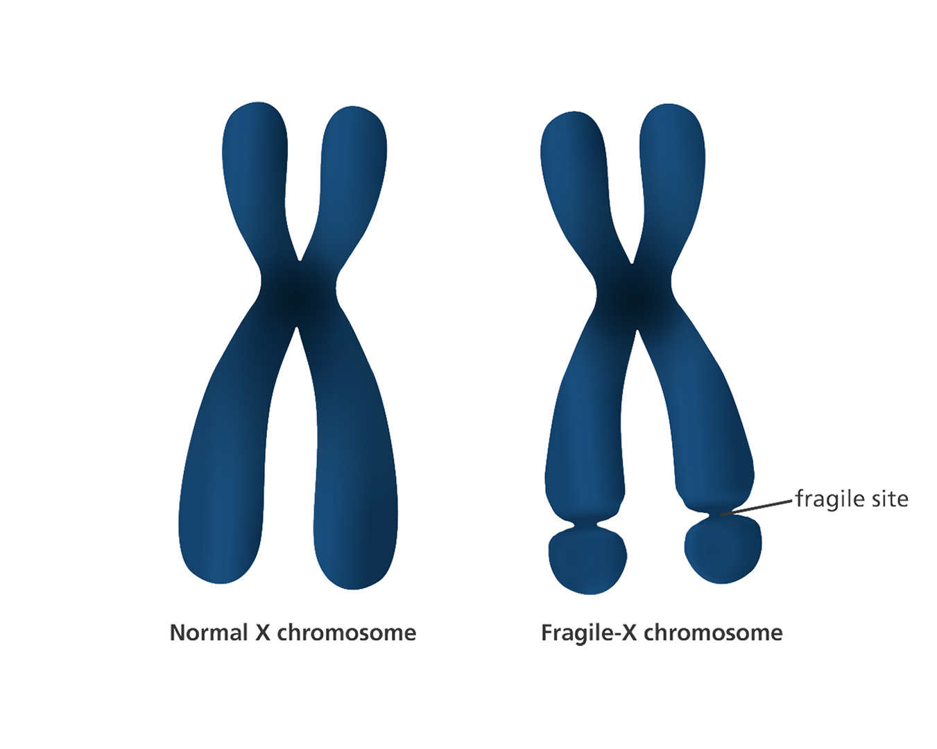 Синдром ломкой Х-хромосомы
