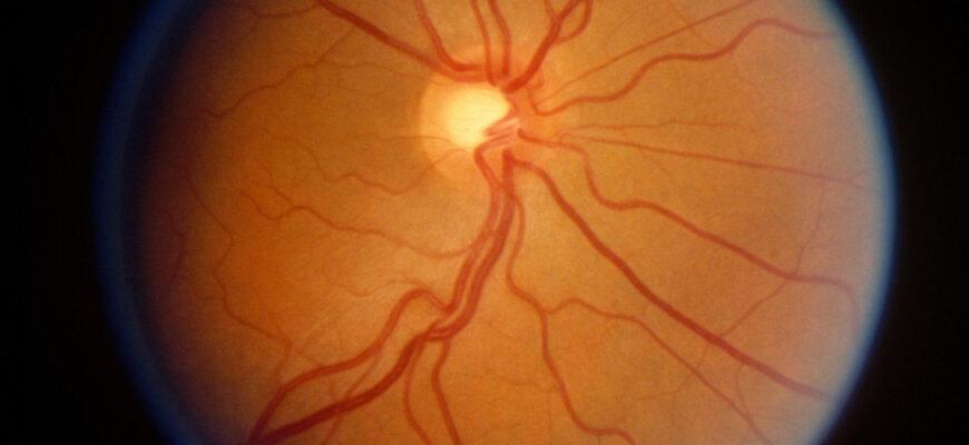 Наследственная оптическая нейропатия Лебера — редкое генетическое заболевание, характеризующееся безболезненной потерей зрения в молодом возрасте. Это вызвано мутациями в митохондриальной ДНК.
