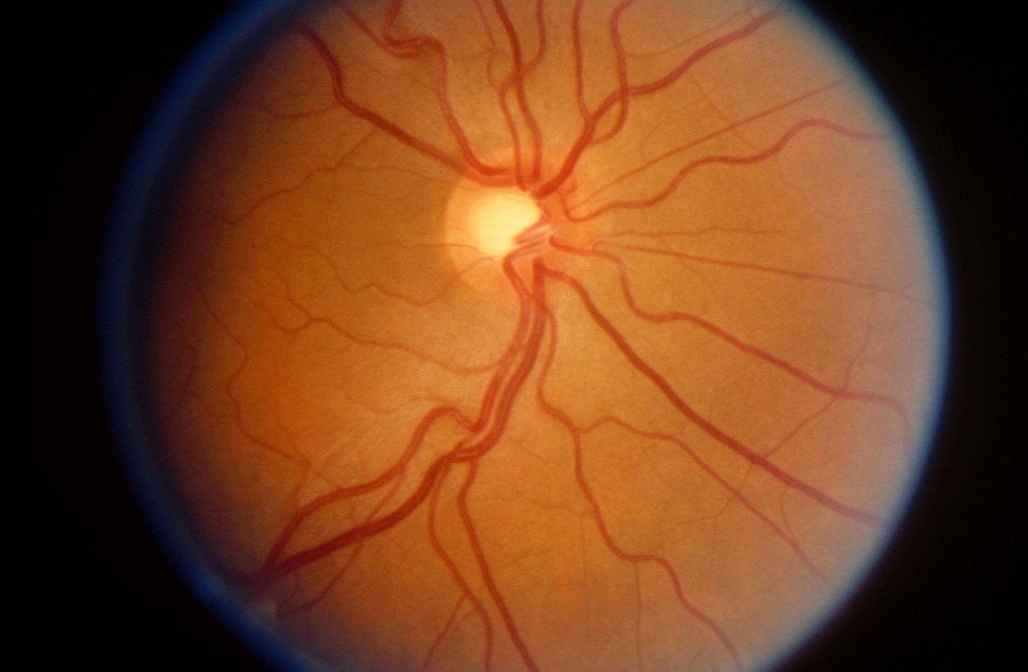 Нейропатия глаза. Атрофия зрительного нерва Лебера. Наследственная нейропатия Лебера.